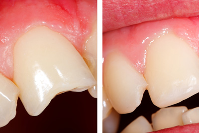 Før- og etterbilde av plastfylling på ødelagt tann